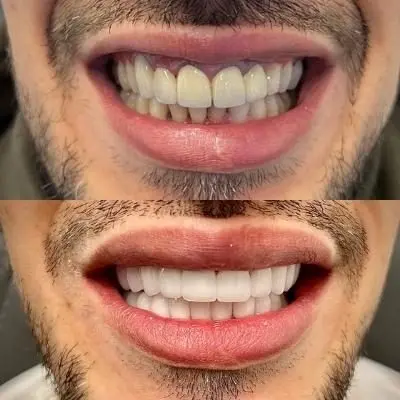 Crowns