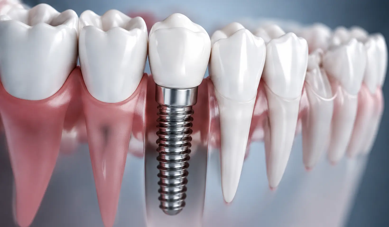 Dental Implants