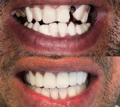 Implant