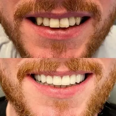 Veneers