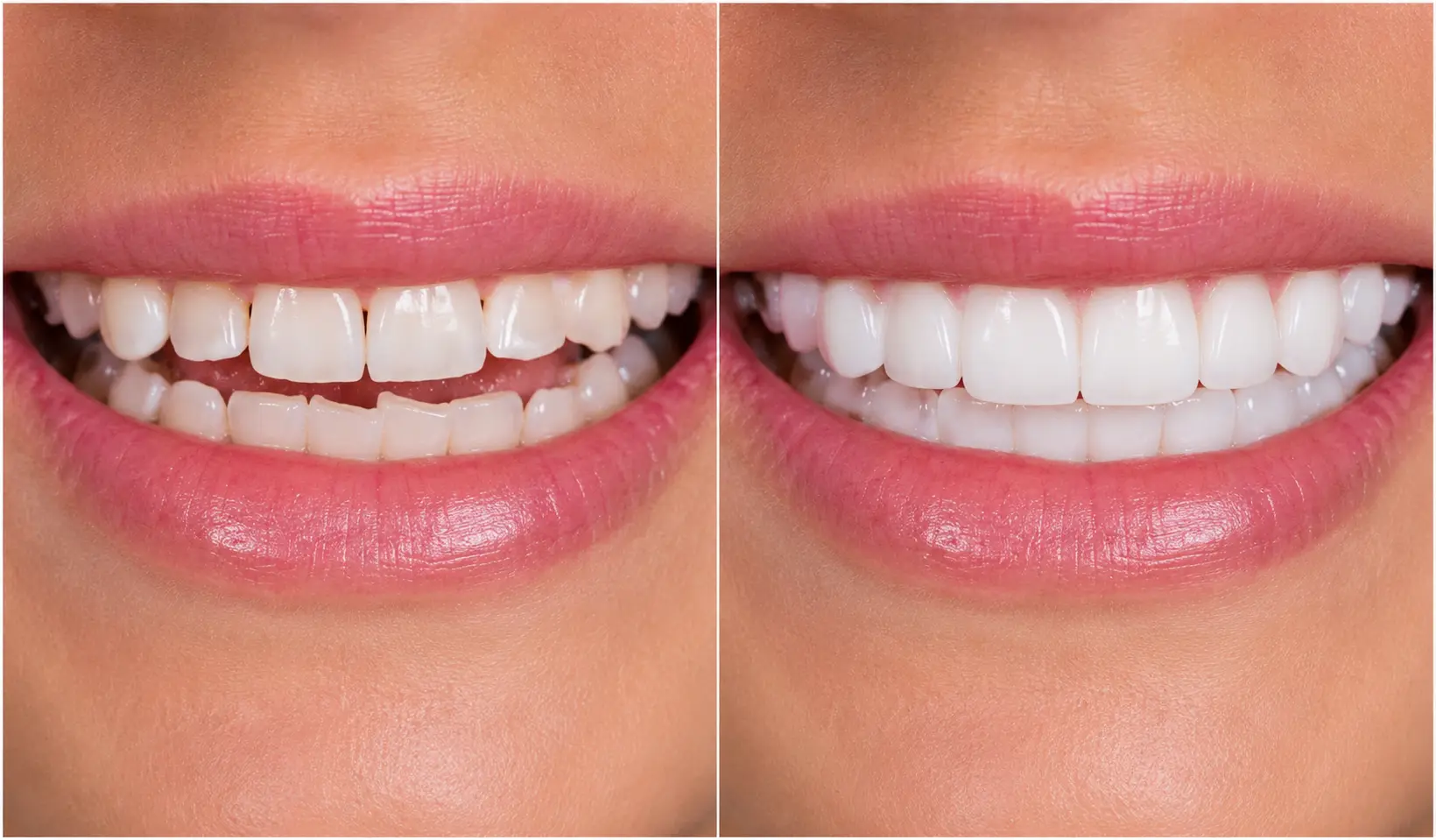Dental Veneers